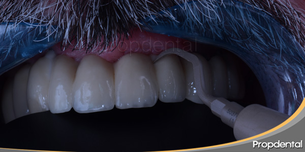 mantenimiento implantes dentales