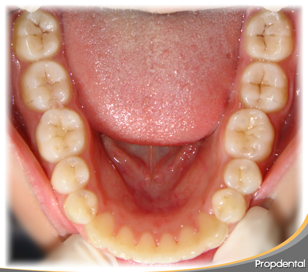 final del tratamiento de Ortodoncia en Propdental