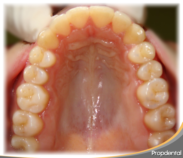 mordida-abierta-invisalign-sup-final