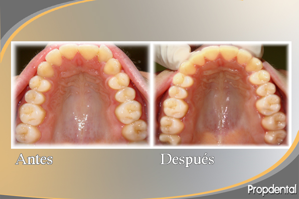 antes y después del tratamiento de la mordida abierta con invisalign