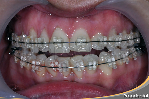 ortodoncia sin extracciones