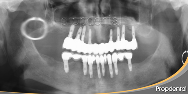 ortopantomgrafía implantes dentales