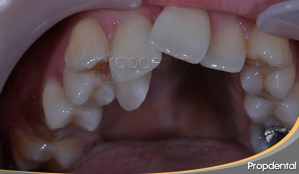 el apiñamiento Tipos de apiñamiento dental