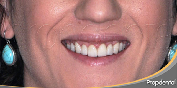 tratamiento de la sonrisa gingival con carillas dentales