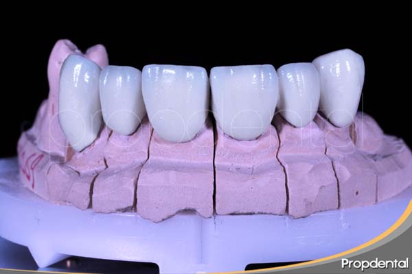 Localización de los dientes de las prótesis dentales
