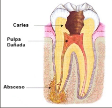 absceso endodóncico