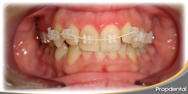 brackets zafiro