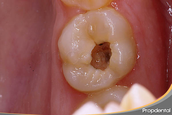 caries-avanzada-con-destruccion-del-esmalte.jpg