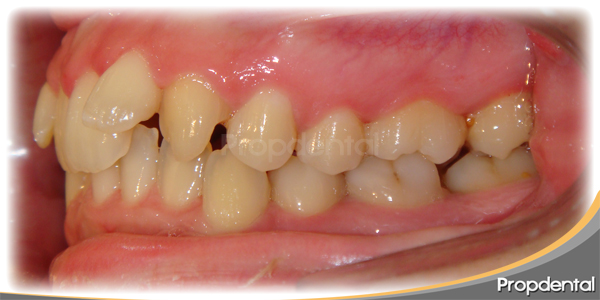 caso clínico aparatos de ortodoncia
