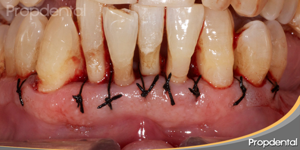caso clínico cirugía periodontal