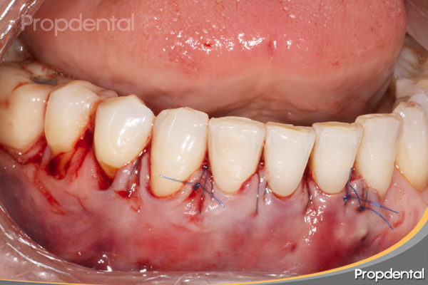 caso clínico de injerto periodontal