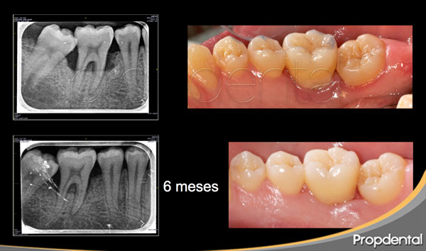 caso clínico regeneración ósea en dientes