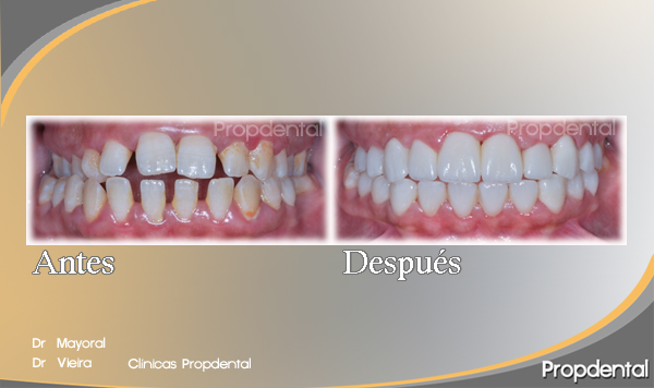 color de las prótesis dentales