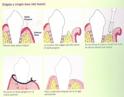 cirugía periodontal Barcelona