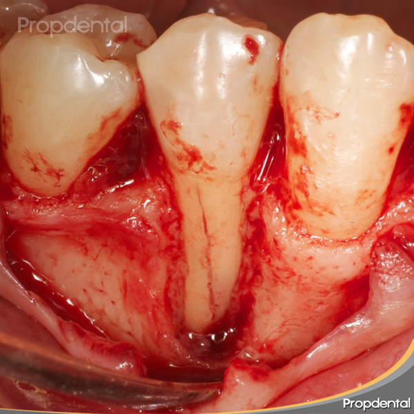 diente con fractura e infección que se va a extraer