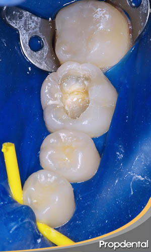 diente endodonciado con estructura dental destruida