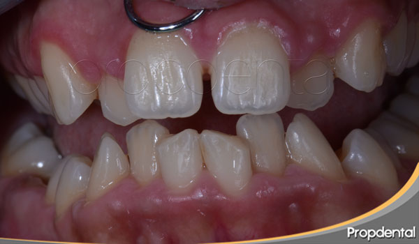 dientes apiñados
