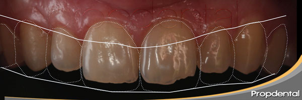 digital smile design con carillas dentales