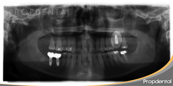 Colocación de implantes en el mismo momento de la elevación de seno