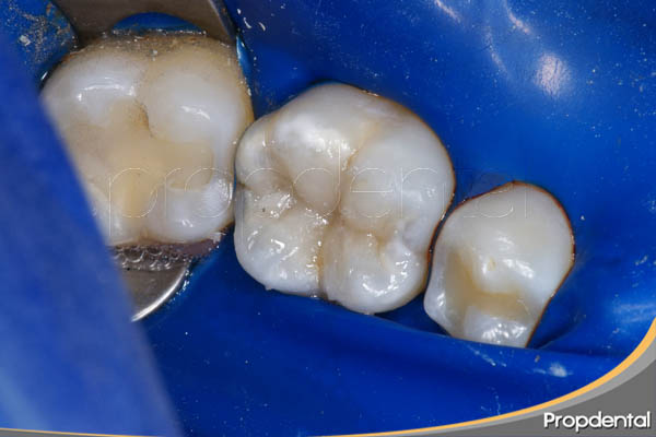 empaste de composite en odontología bioenergética