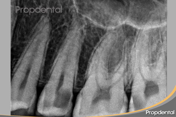 endodoncia diente multirradicular