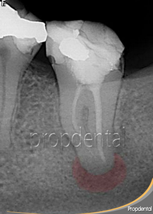 endodoncia mal hecha