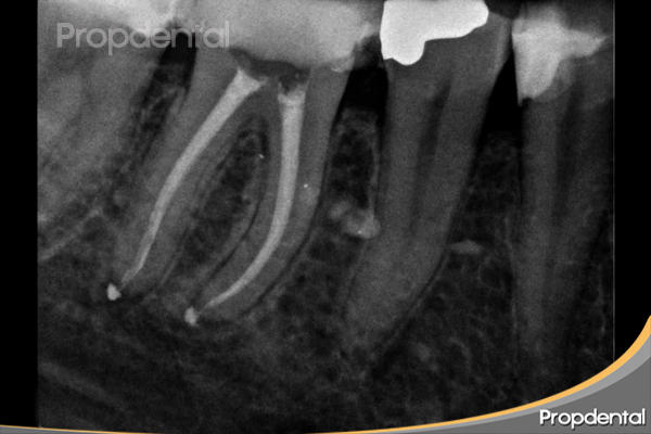 endodoncia molar inferior