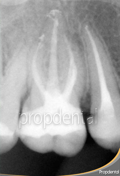 endodoncia molar superior