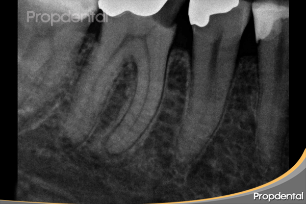 endodoncia multirradicular de molares