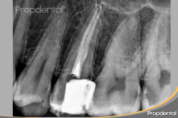 endodoncia premolar superior