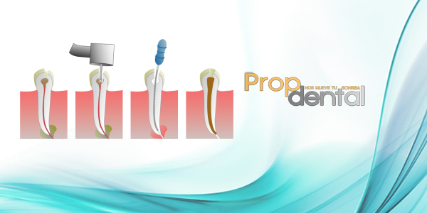 endodoncia unirradicular barcelona