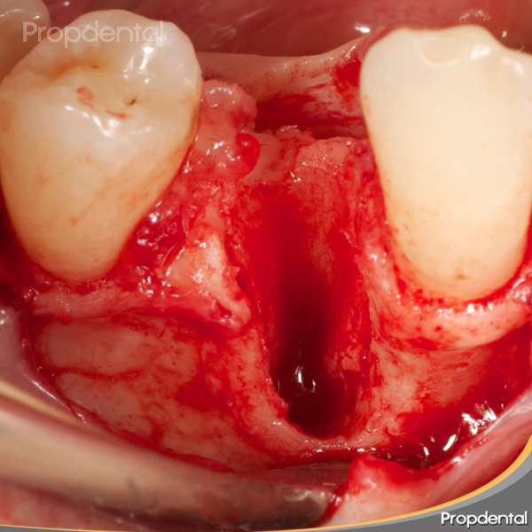 falta de hueso para implantes dentales