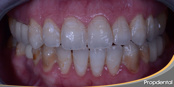 fluorosis manchas blancas del esmalte