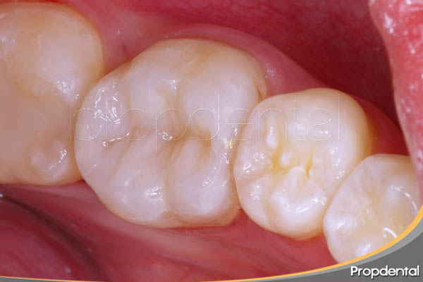incrustación de composite dental en Propdental