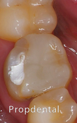 incrustación dental composite en Barcelona
