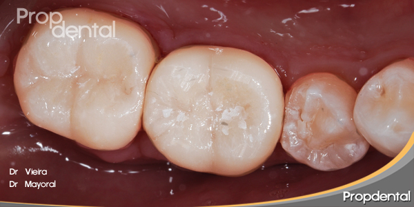 incrustación overlay propdental