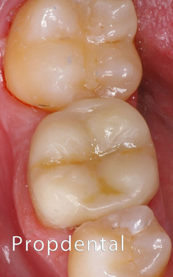 indicación incrustaciones composite dental