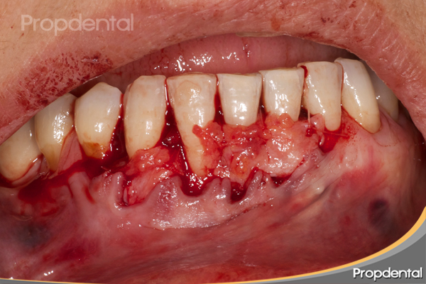 injerto periodontal