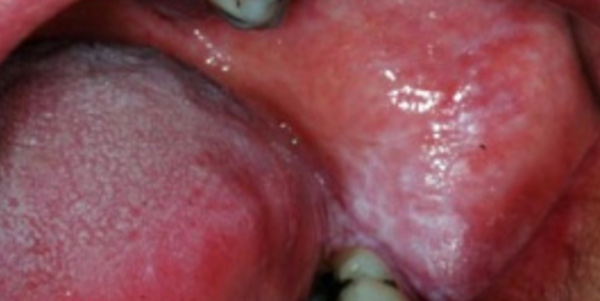 leucoplasia oral
