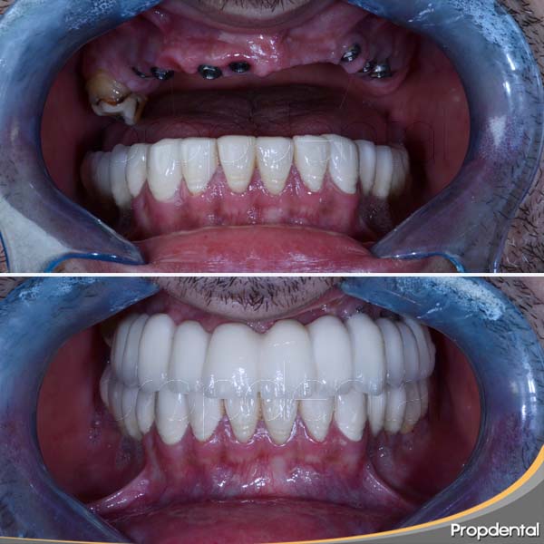 osteointegración de los implantes dentales