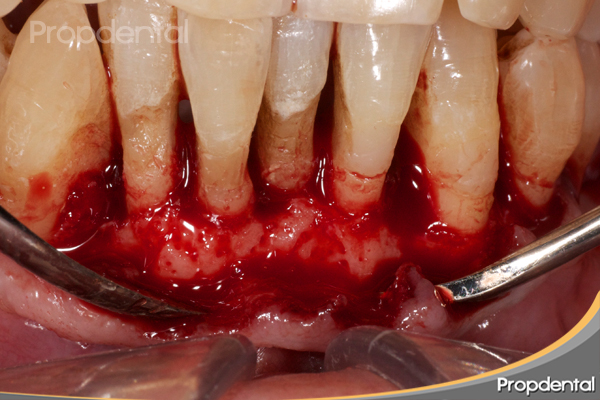 osteoplastia y regularización hueso