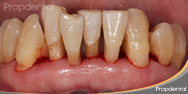 periodontitis avanzada