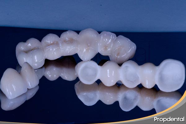 puente dental de circonio