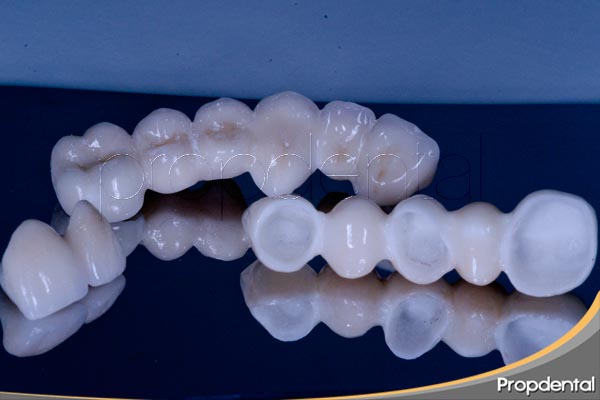 puente dental de circonio