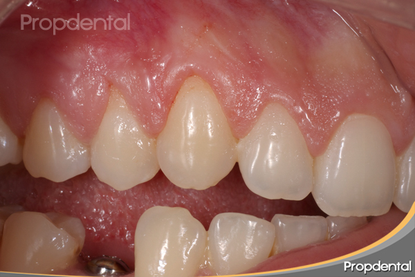 recesión gingival