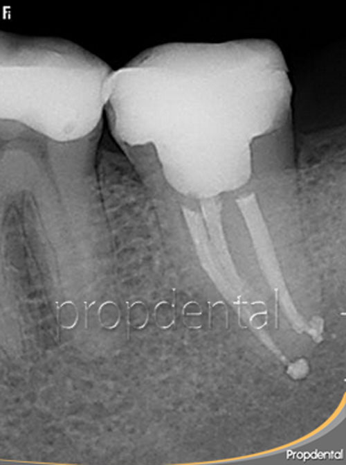 reendodoncia barcelona