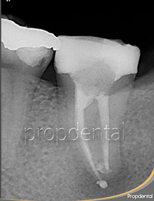 reendodoncia