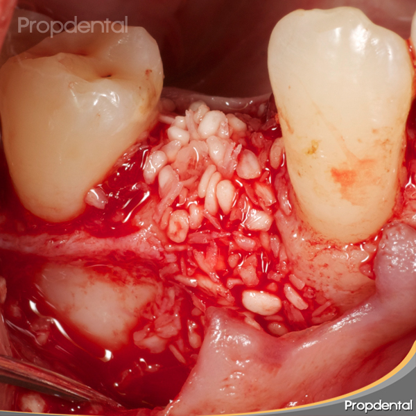 caso clínico de regeneración ósea guiada