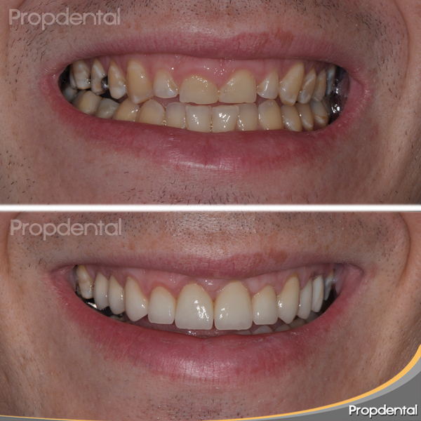 sonrisa antes y después del tratamiento con prótesis dentales