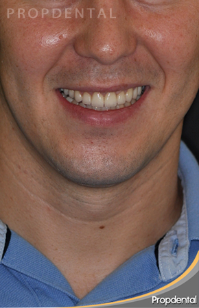 sonrisa antes del tratamiento de estética dental
